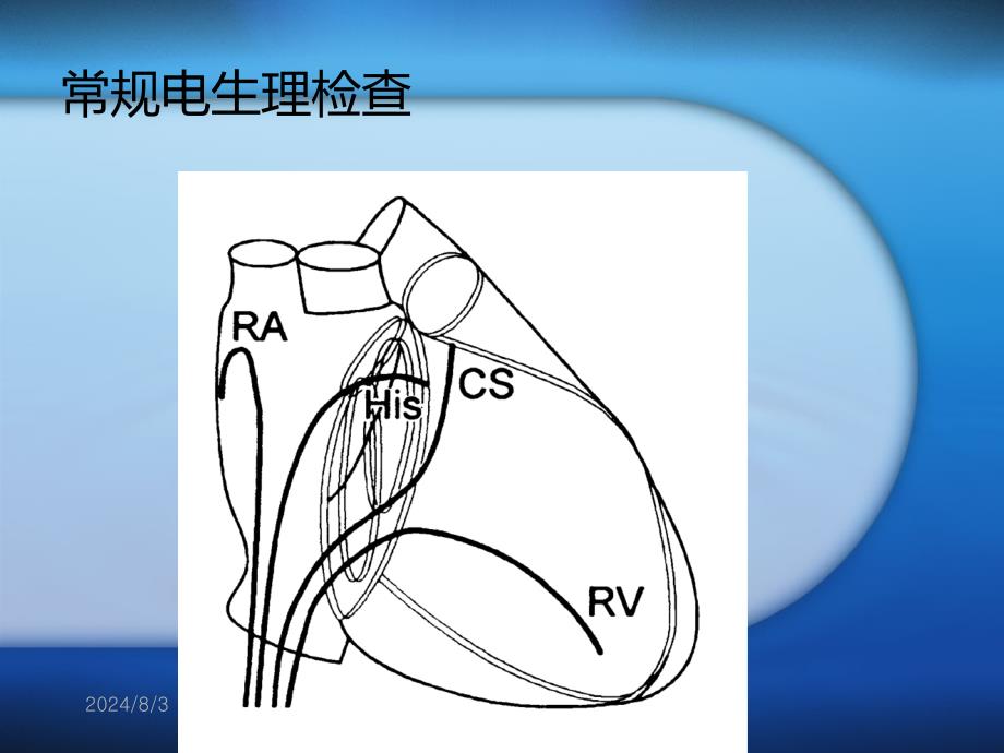 射频消融术及其护理1课件_第4页