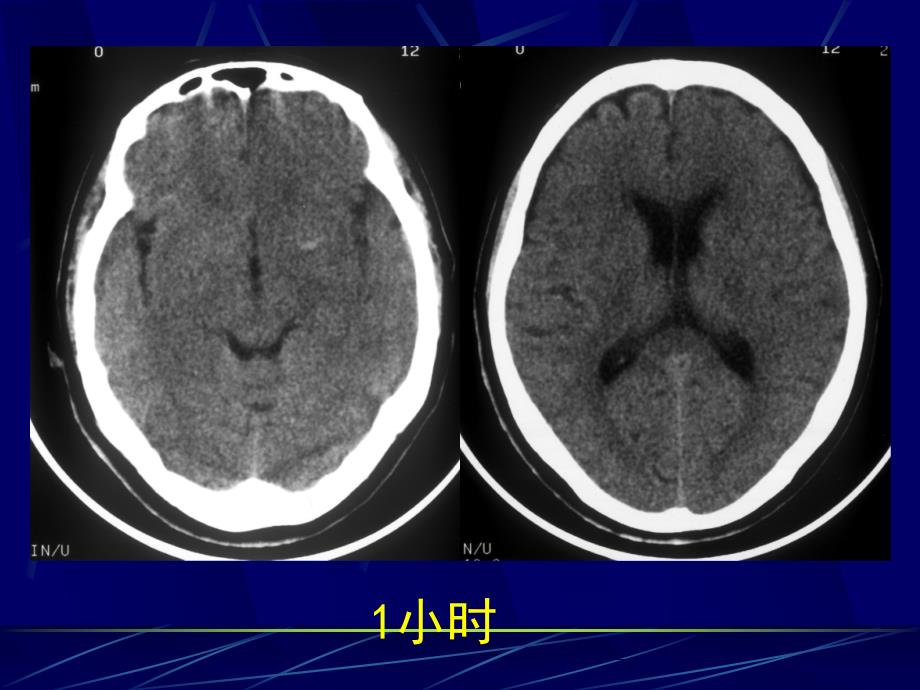 医学影像学：4中枢神经系统第二章第四节脑血管疾病_第3页