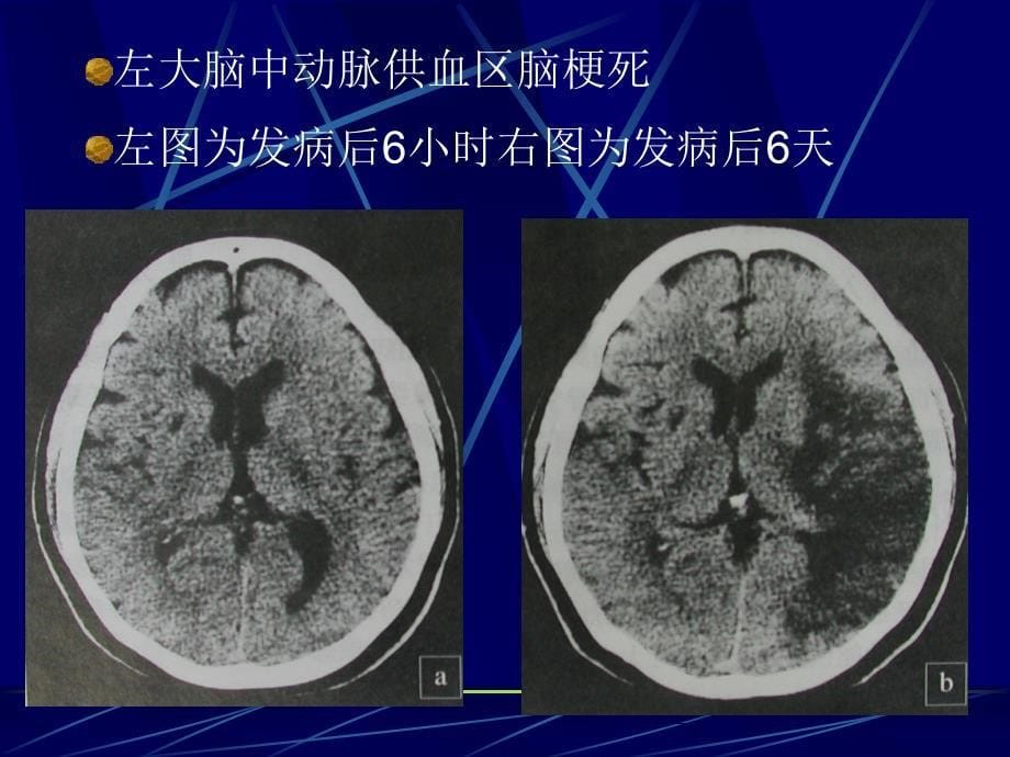 医学影像学：4中枢神经系统第二章第四节脑血管疾病_第5页