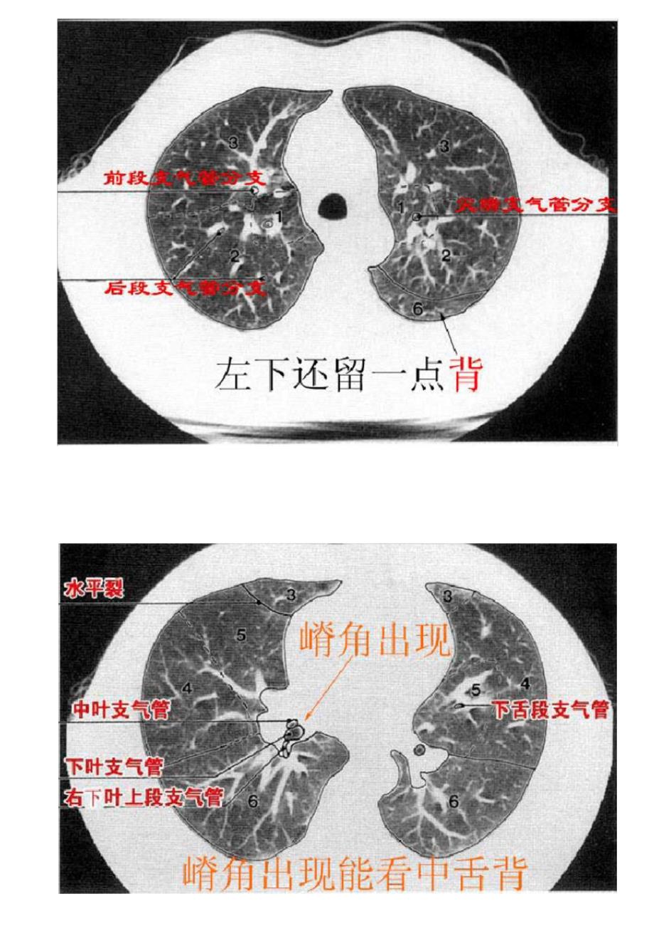 CT肺的分叶分段_第2页