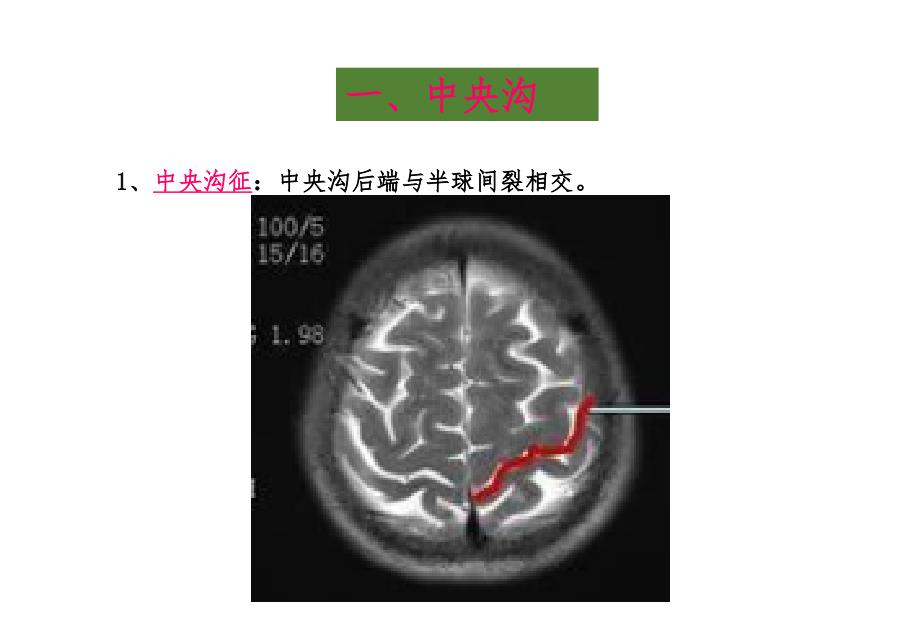 脑沟回特殊征象_第2页