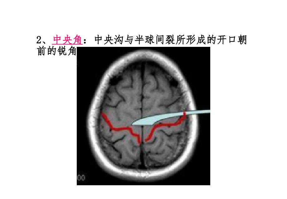 脑沟回特殊征象_第3页