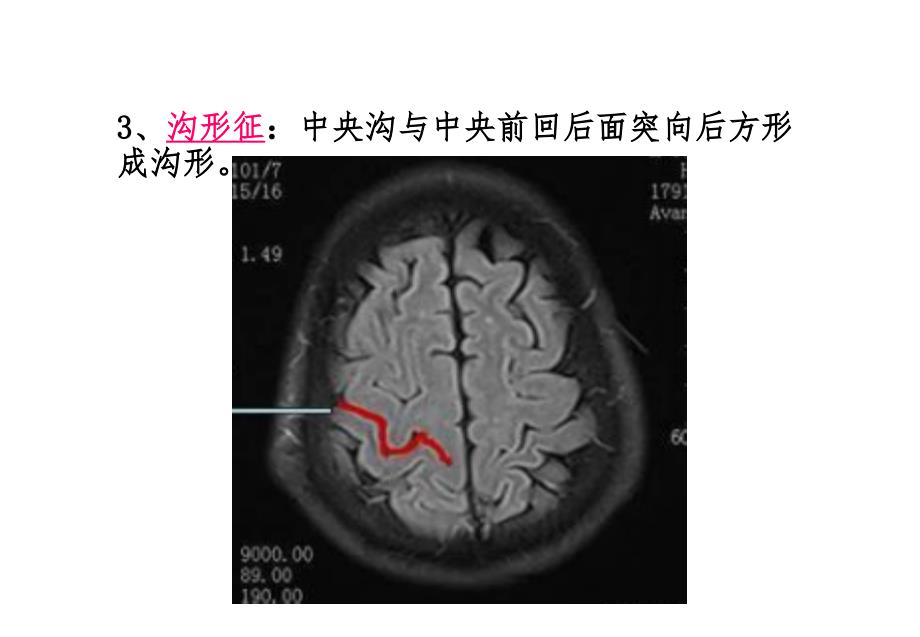 脑沟回特殊征象_第4页