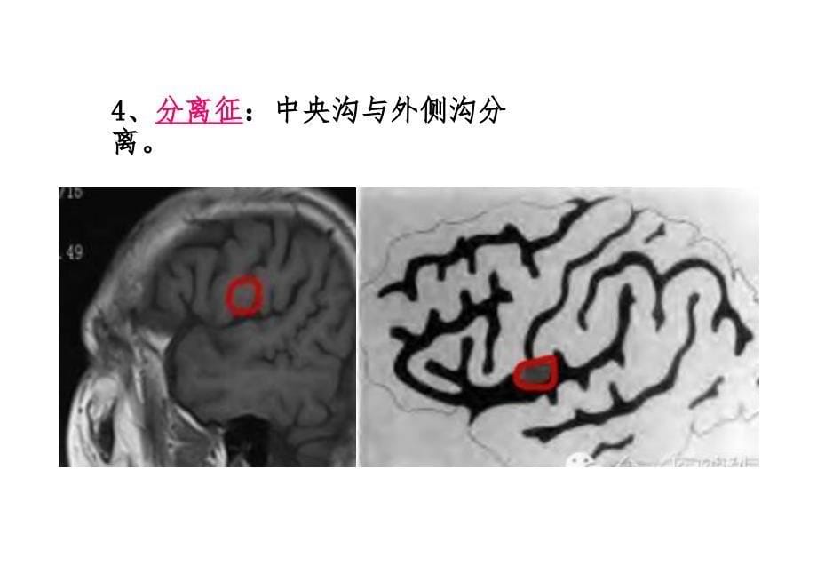 脑沟回特殊征象_第5页