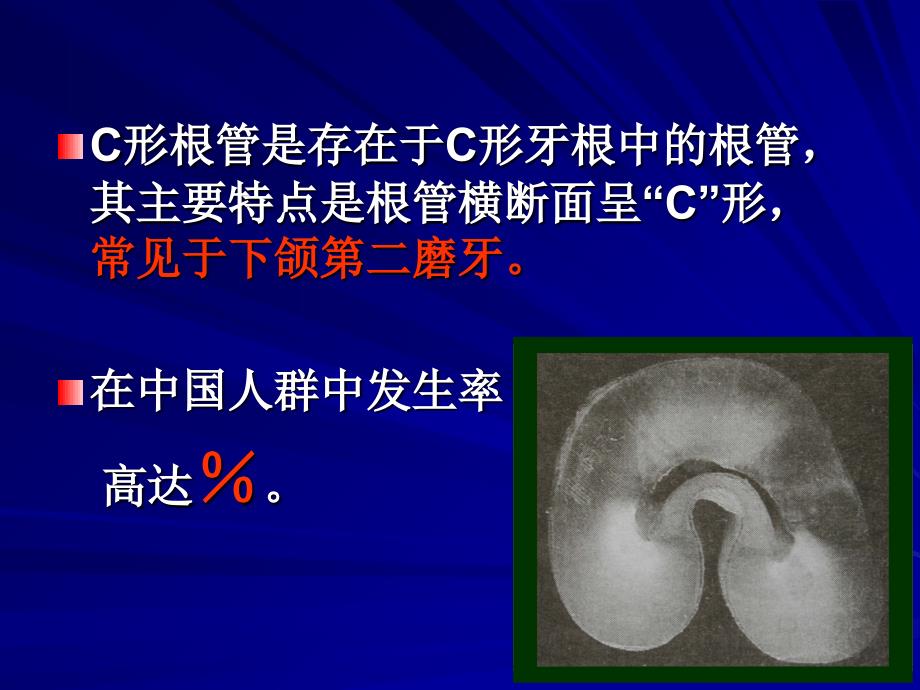 C形根管的形态、识别和治疗_第2页