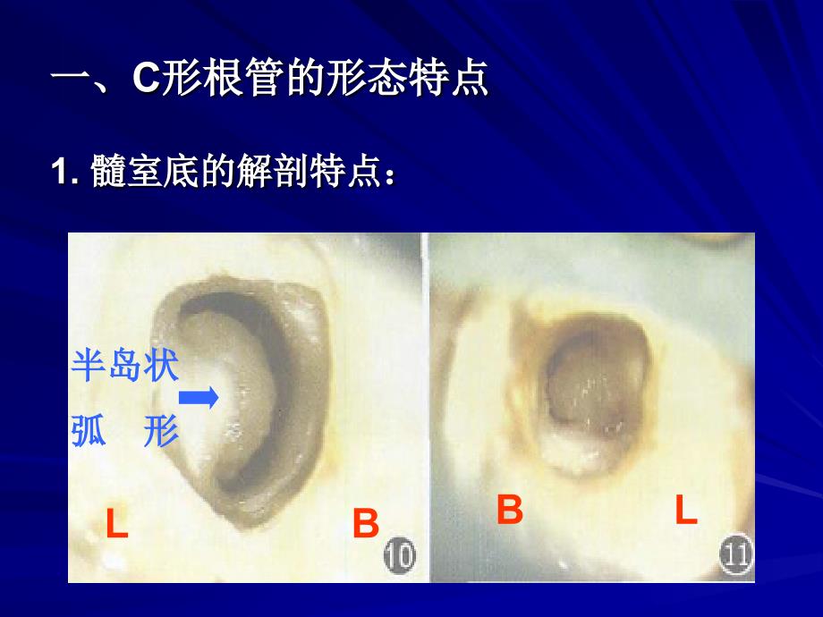 C形根管的形态、识别和治疗_第4页