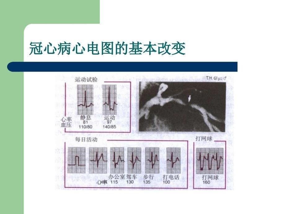 心电图冠状动脉病变_第5页