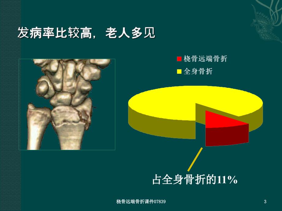 桡骨远端骨折课件07839_第3页