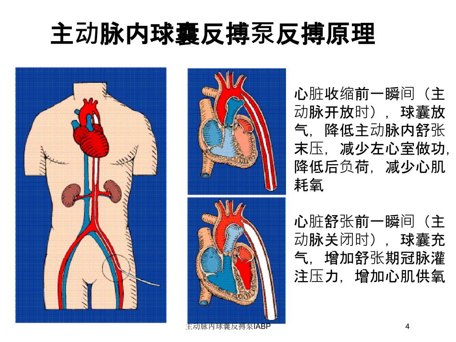 主动脉内球囊反搏泵IABP培训课件_第4页