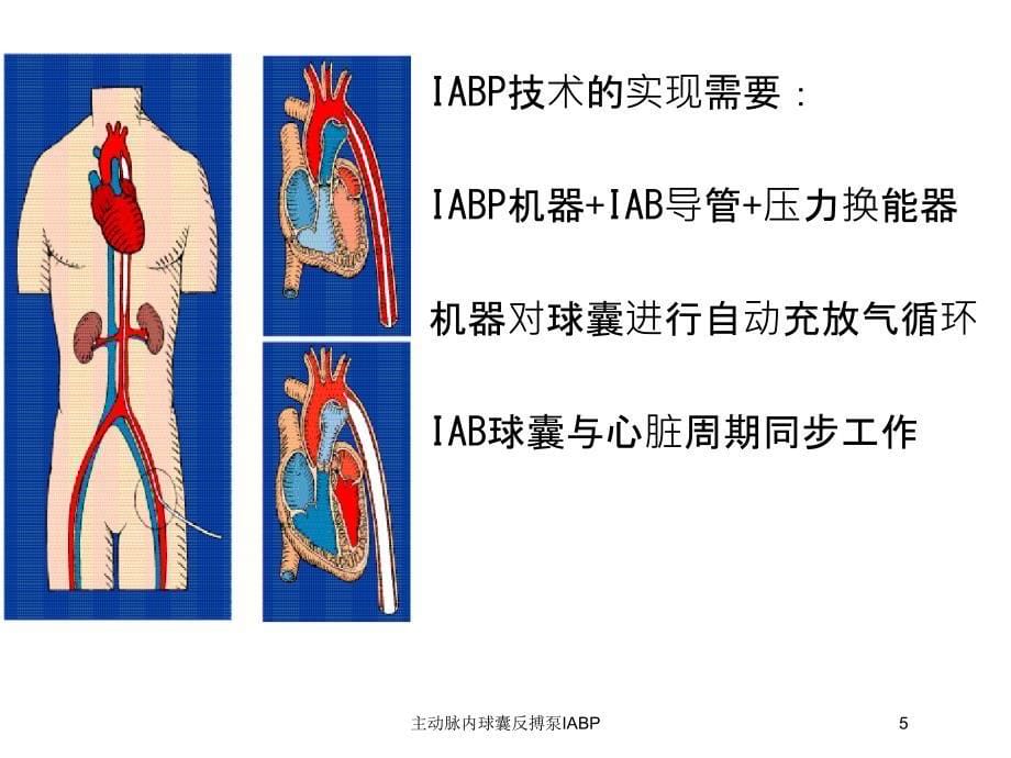 主动脉内球囊反搏泵IABP培训课件_第5页