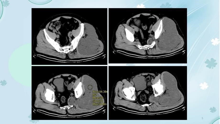 脂肪肉瘤的影像表现_第5页