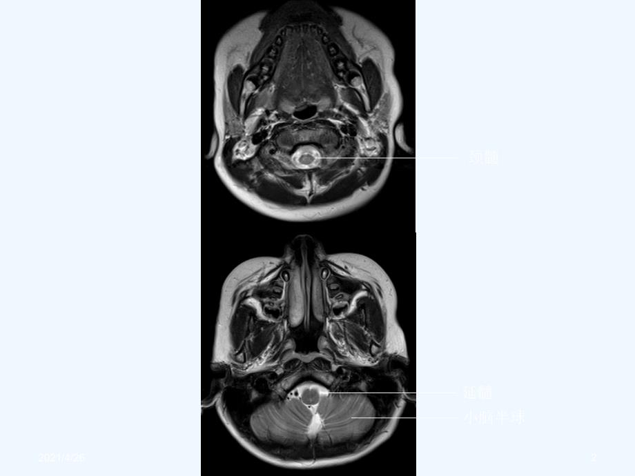 头颅CT与MRI的正常图像_第2页