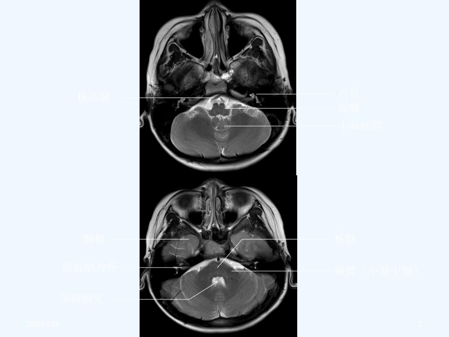 头颅CT与MRI的正常图像_第3页