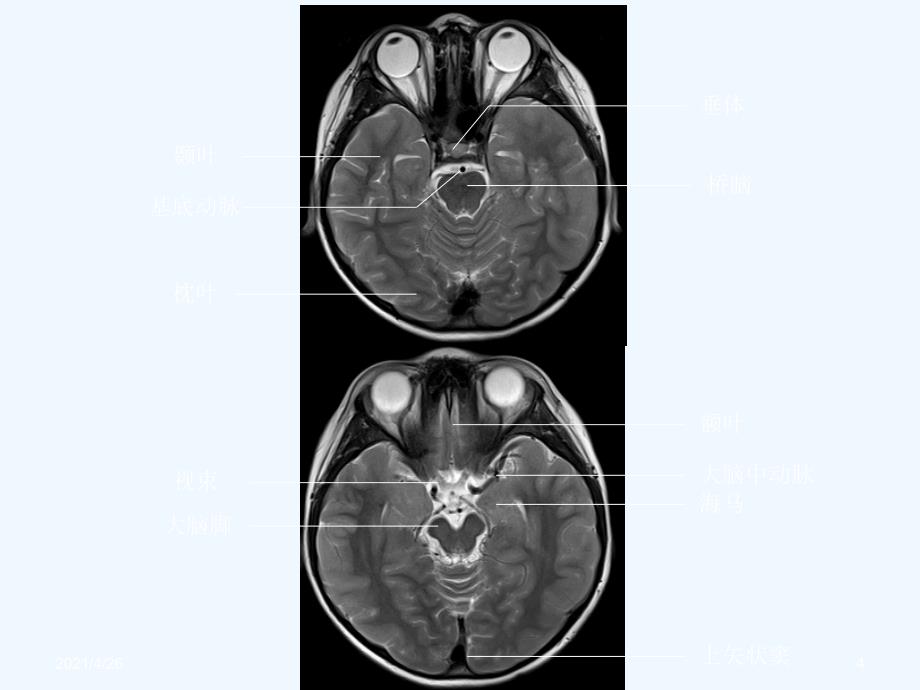 头颅CT与MRI的正常图像_第4页