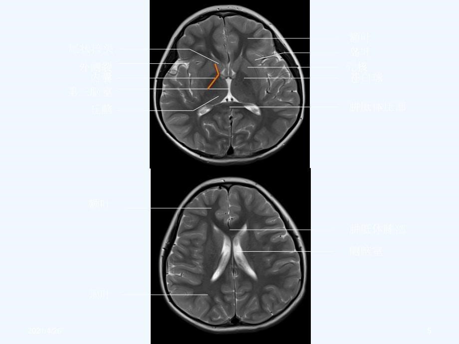 头颅CT与MRI的正常图像_第5页