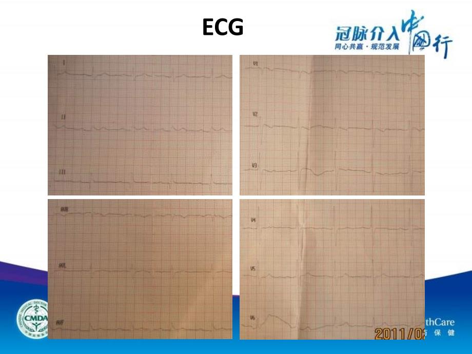 疑难病例汇报LM分叉病变并多支病变的介入治疗课件_第4页