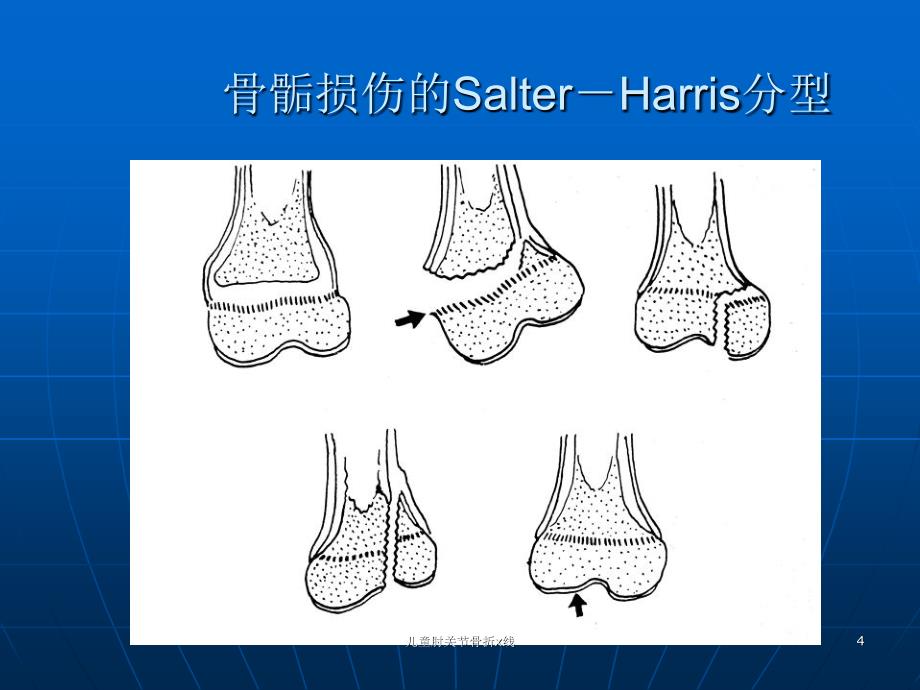 儿童肘关节骨折x线课件_第4页