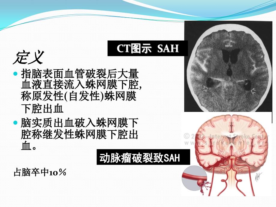 蛛网膜下腔出血诊治流程_第2页