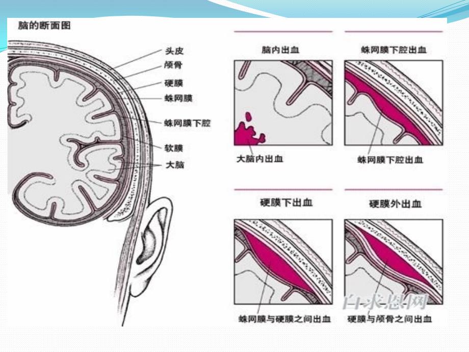 蛛网膜下腔出血诊治流程_第4页