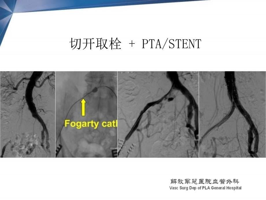 杂交技术在下肢动脉病变中的应用郭伟_第5页