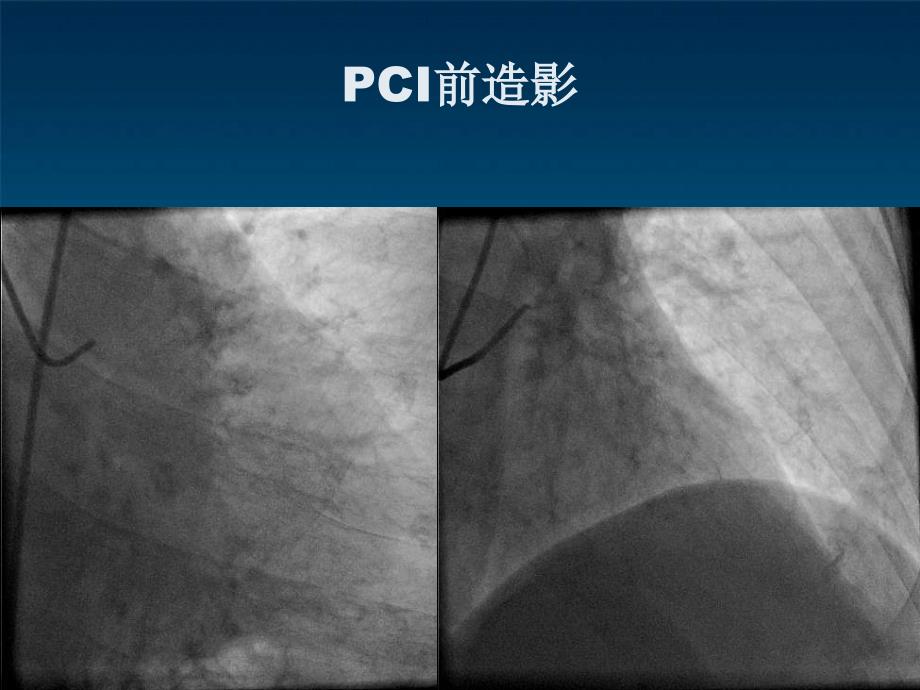 冠脉导丝引起冠脉小血管穿孔病例分析ppt课件_第3页