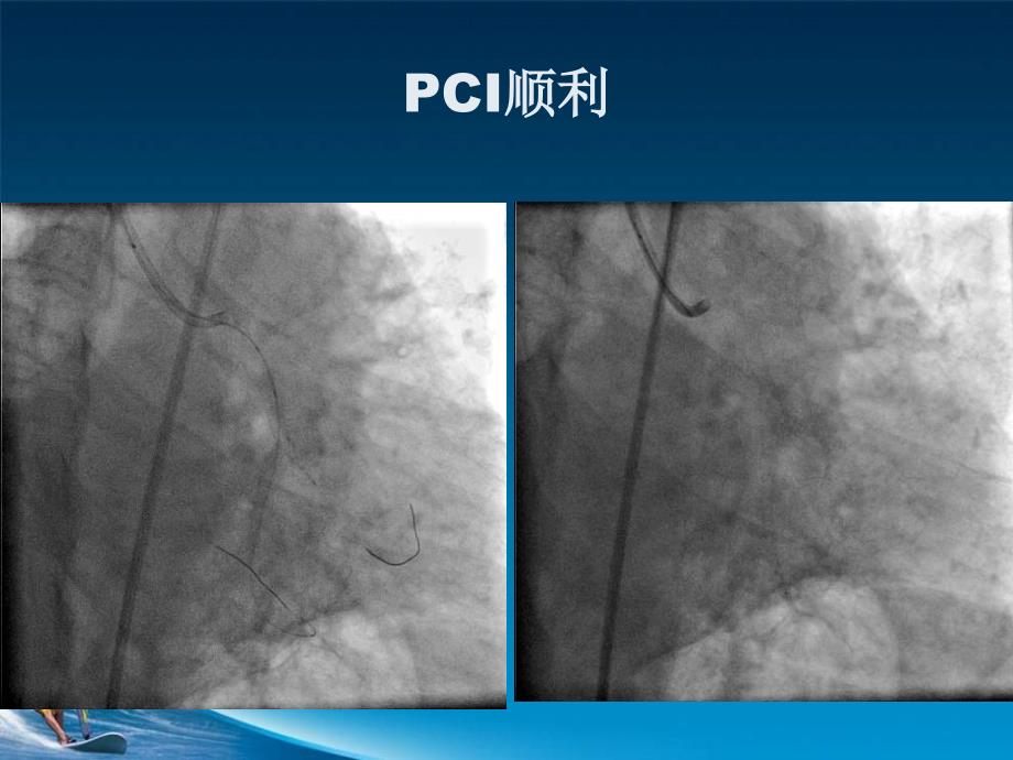 冠脉导丝引起冠脉小血管穿孔病例分析ppt课件_第4页