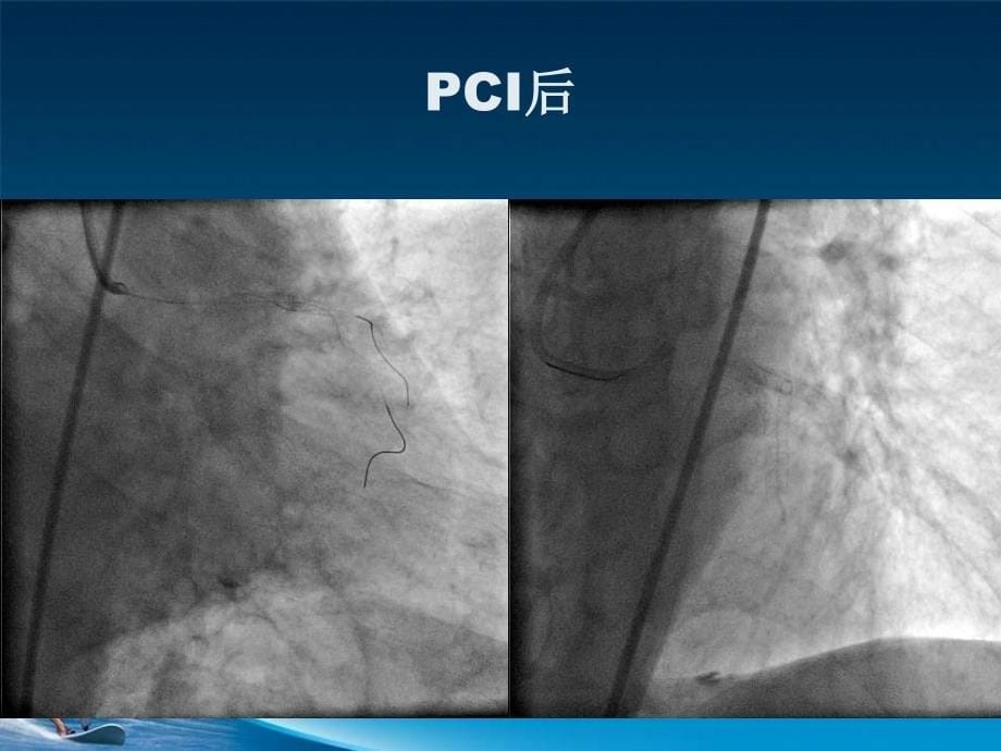 冠脉导丝引起冠脉小血管穿孔病例分析ppt课件_第5页