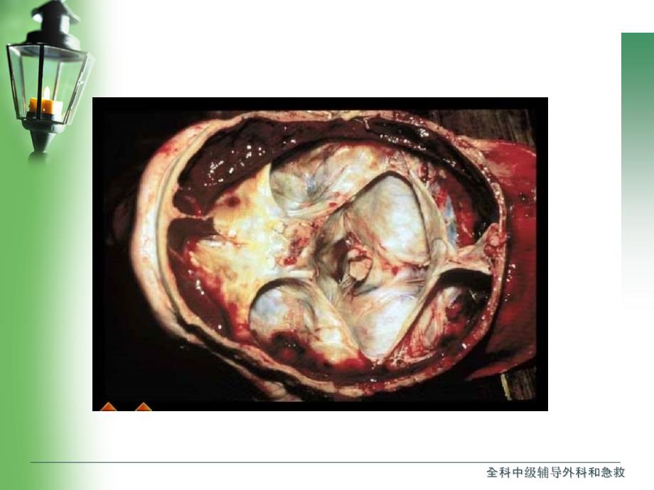 全科中级辅导外科和急救课件_第3页