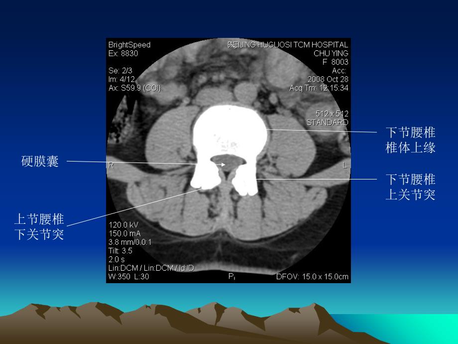 腰椎CT诊断(1)教学文案_第4页