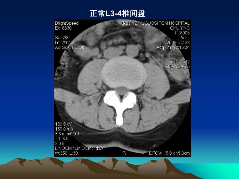 腰椎CT诊断(1)教学文案_第5页