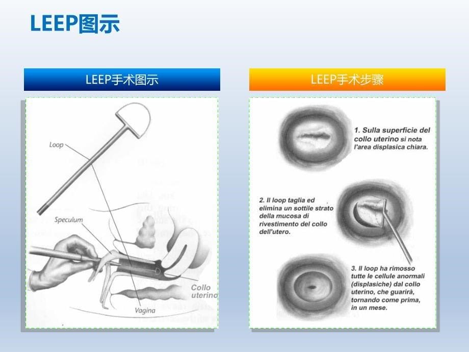 LEEP在妇产科的应用ppt课件_第5页