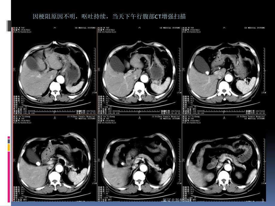 阑尾炎肠梗阻读课件_第3页