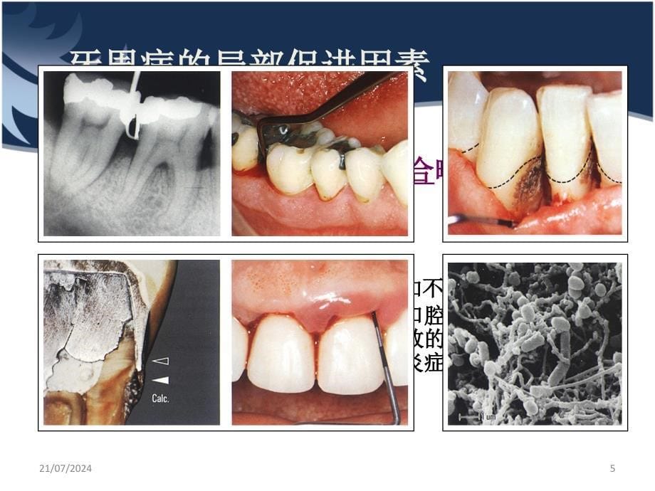 牙周病的局部及全身促进因素ppt参考课件_第5页