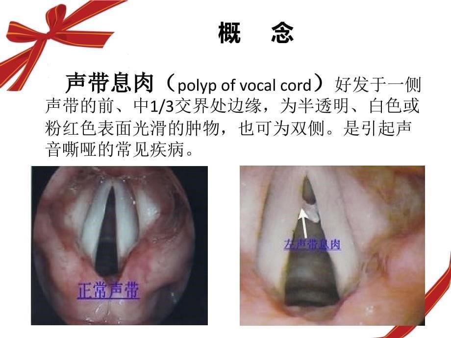 声带息肉护理查房ppt课件_第5页