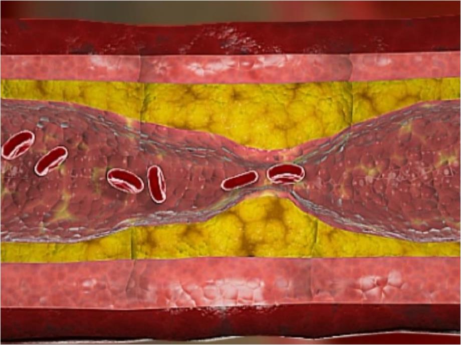 动脉硬化与冠心病PPT课件_第4页
