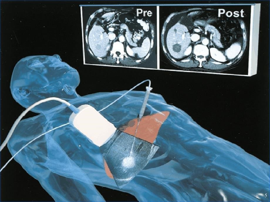 实体肿瘤射频消融研究进展ppt课件_第5页