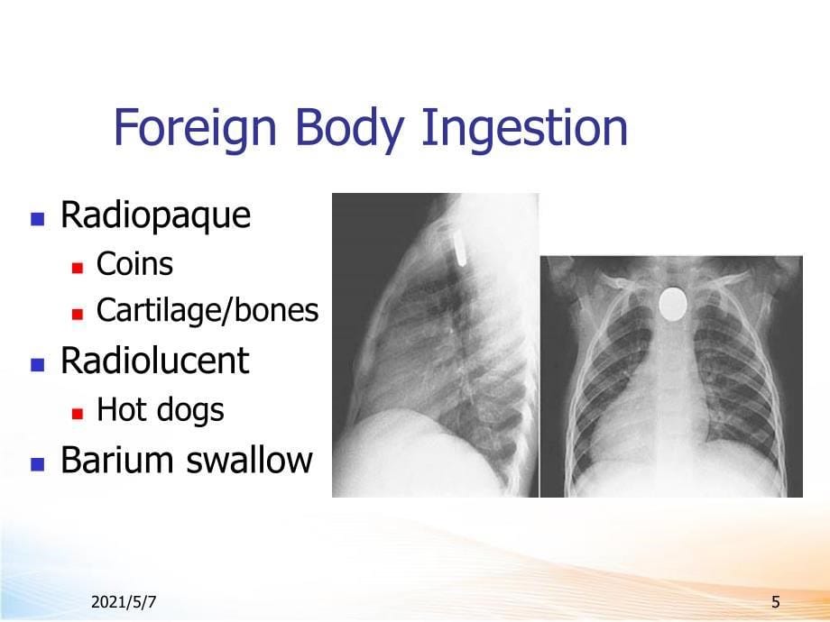 异物讲座课件_第5页