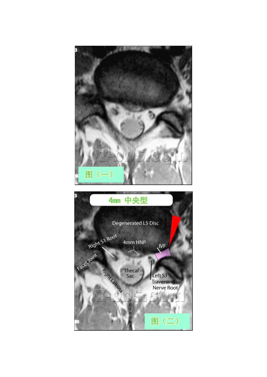 学会看腰椎间盘突出CT和MRI磁共振片子的超好.doc_第4页