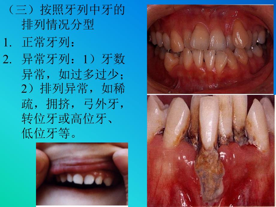 第三章牙列颌位_第4页