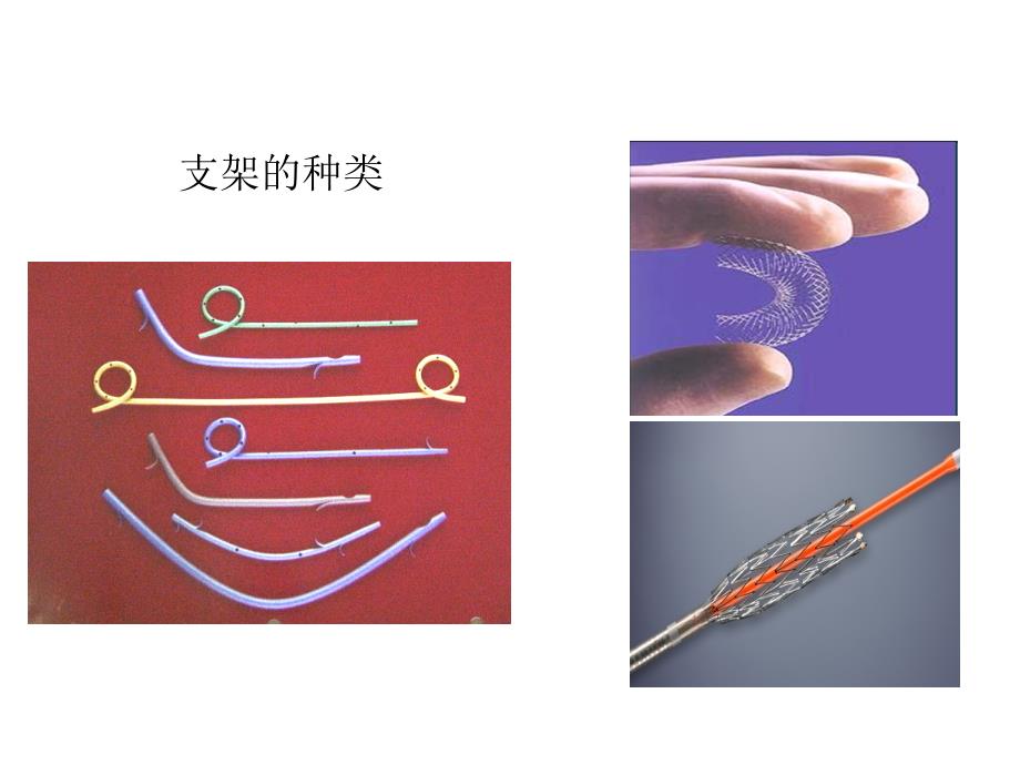 ERCP下胆道胰管支架置入讲述_第3页