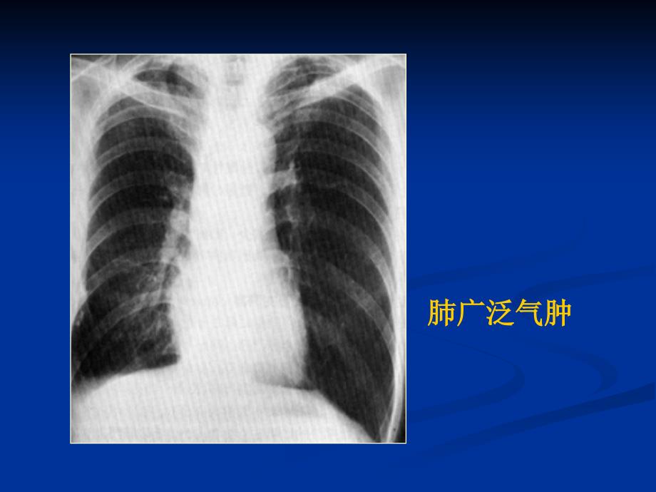 肺部基本病变影像改变_第4页