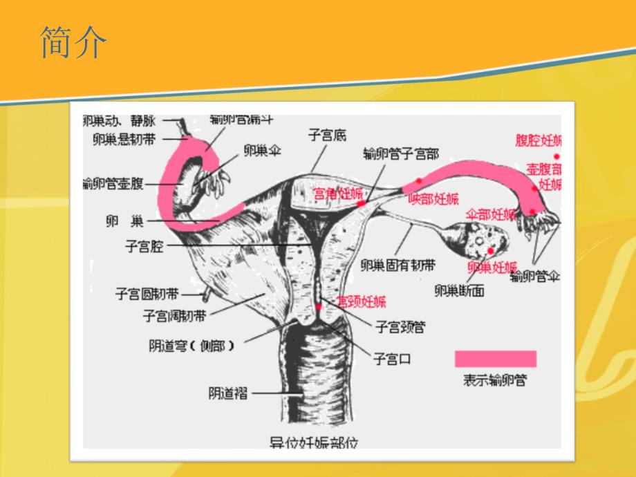 输卵管异位妊娠PPT课件_第4页