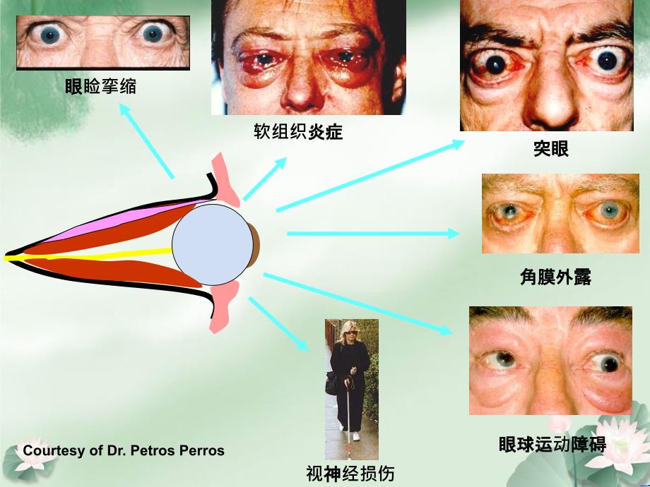 甲状腺相关性眼病的诊治_第3页