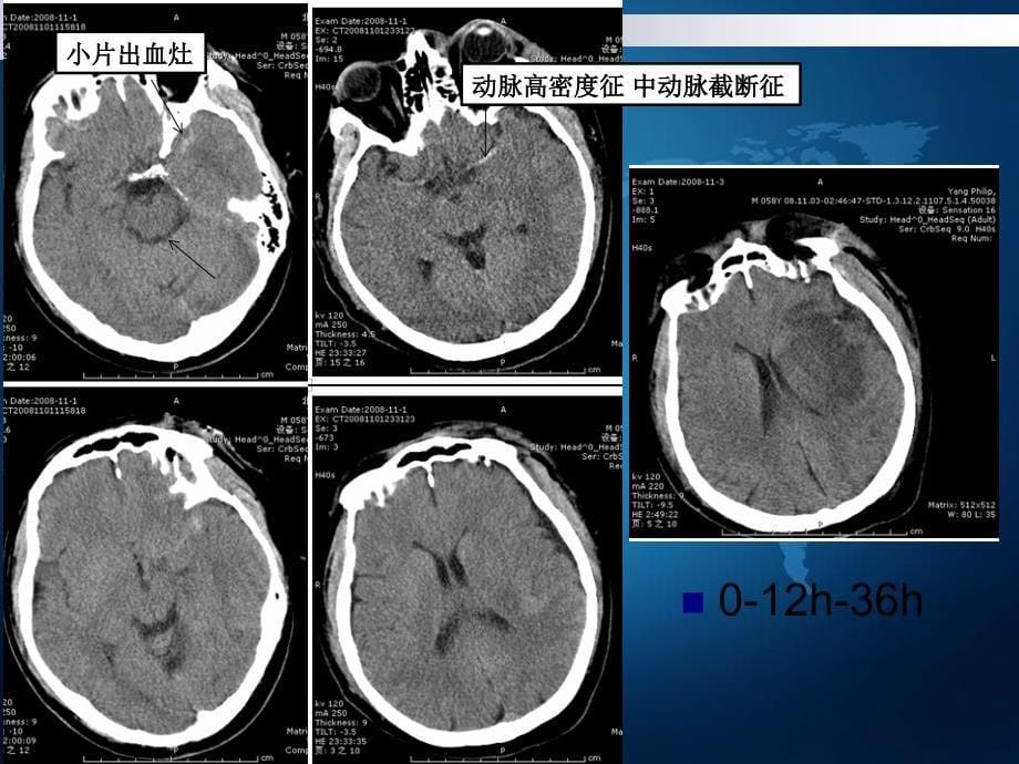 《神经系统实习读片》课件_第5页