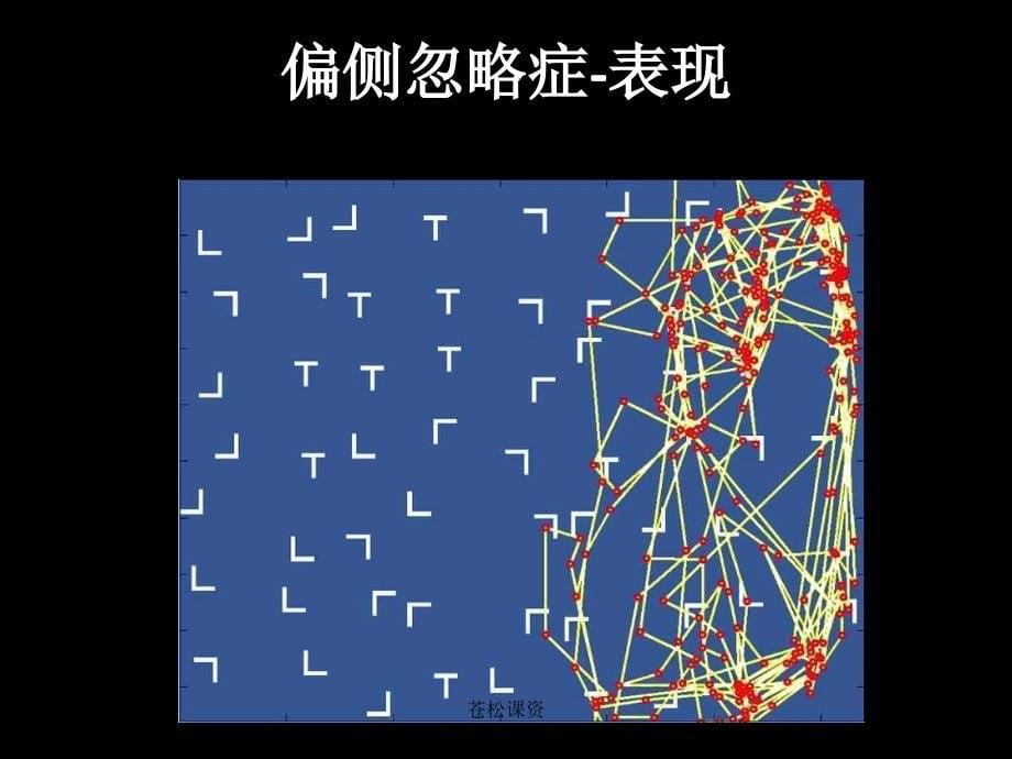 单侧忽略的概述、评定与治疗【专业教学】_第5页