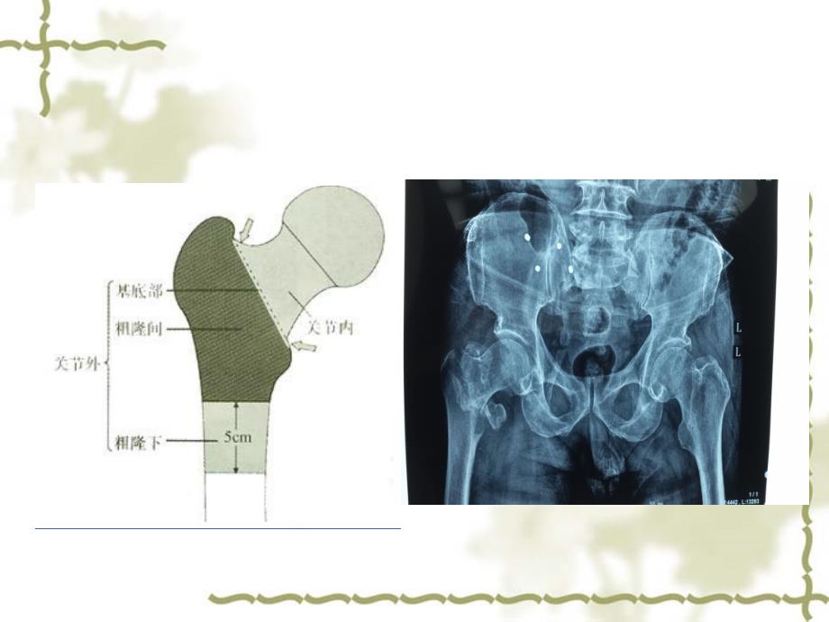 股骨粗隆间骨折手术配合_第4页