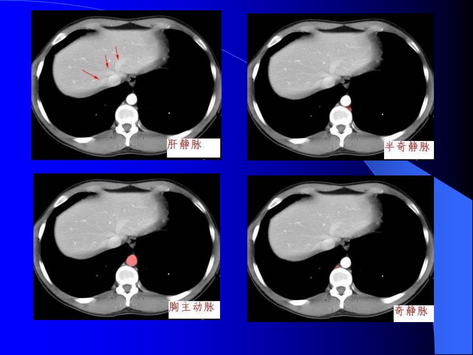 肝胆胰脾的CT诊断_第4页