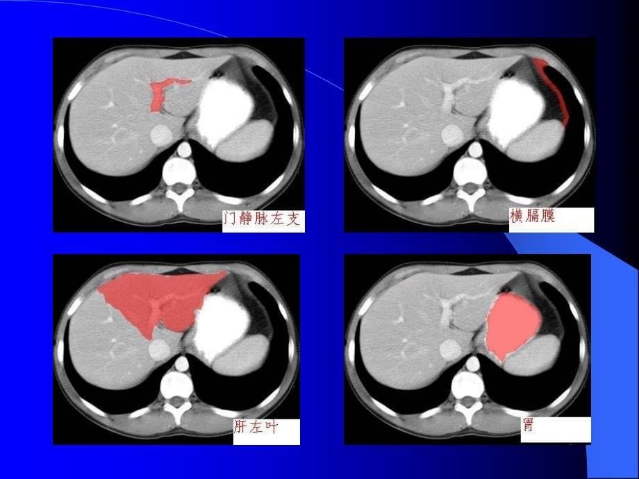 肝胆胰脾的CT诊断_第5页