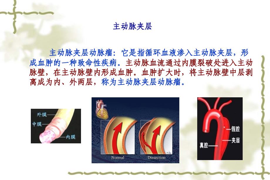 Ⅰ型夹层动脉瘤并发术后肺不张_第4页