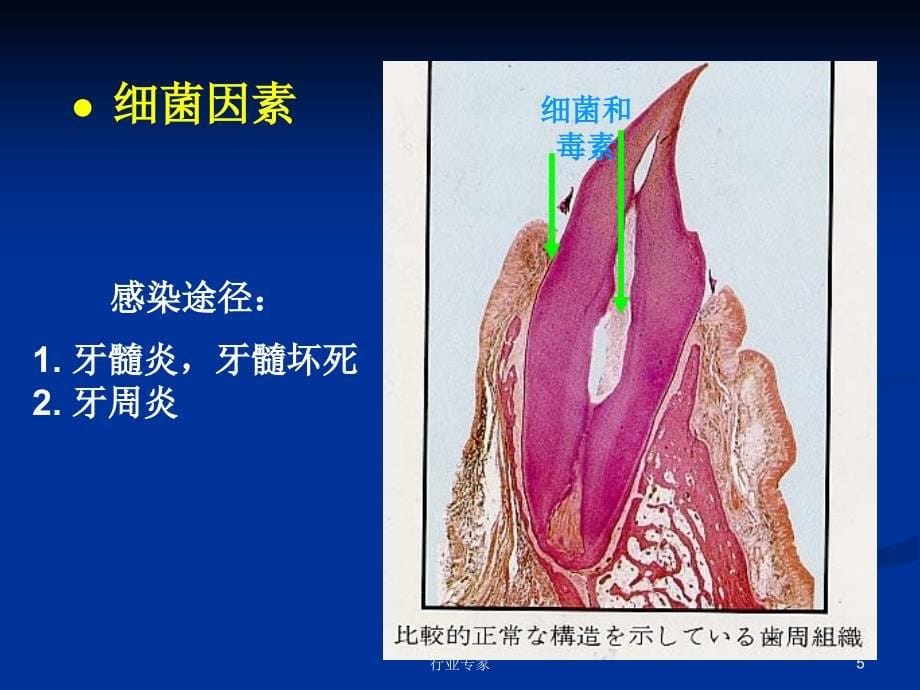 牙齿根尖周炎的分类和病理行业严选_第5页